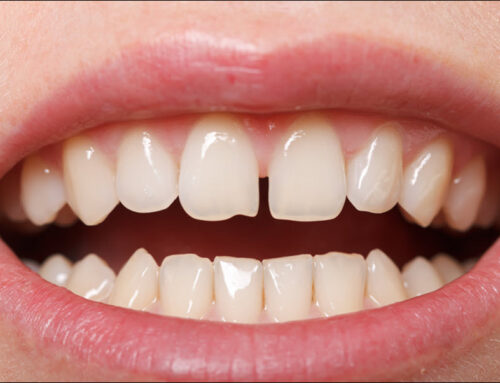 How Dental Bonding Repairs Chipped Teeth