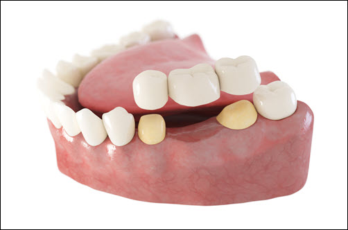 Dental Bridges2