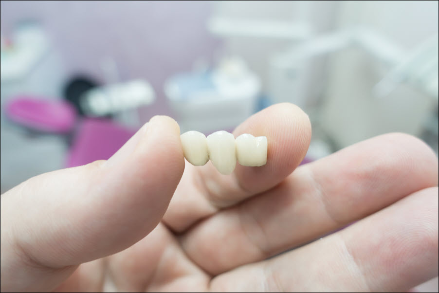 Dental Bridges3
