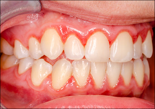 Gingivitis2