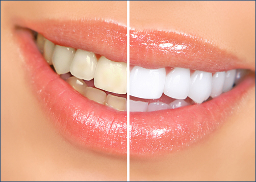 Teeth Whitening