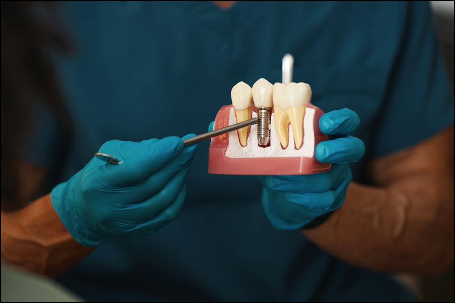 Dental Implants